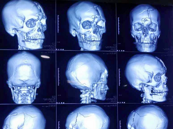 Help Kiran Recover From A Head Injury Due To an Accident!