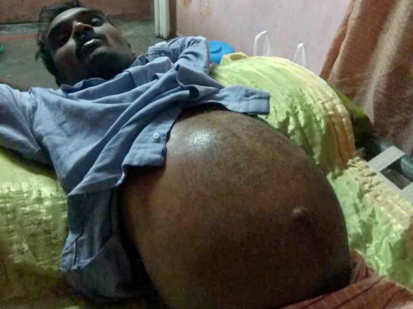Support Kalla Anantha Undergo Liver Transplant