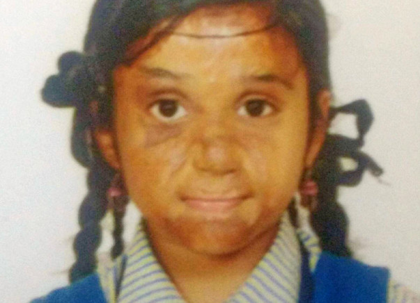 Madhupriya Needs Your Help To Recover From Severe Burns