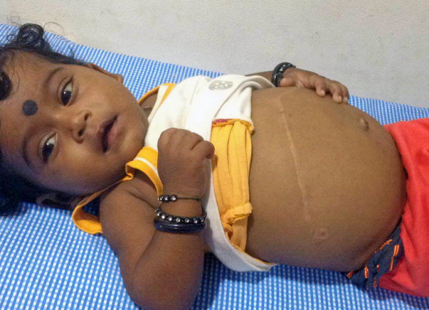 Help this 7-month-old undergo a liver transplant