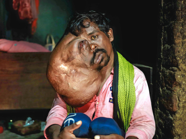 Help Manbodh Undergo Treatment For Facial Tumor