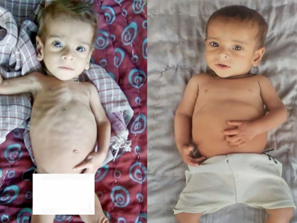 You can save lives of 500 malnourished children in Rajasthan!