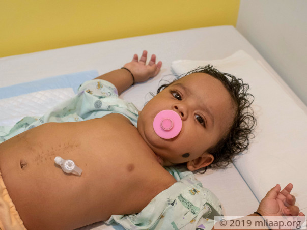 This Baby Who Is Fed Through A Hole In His Stomach Needs Surgery
