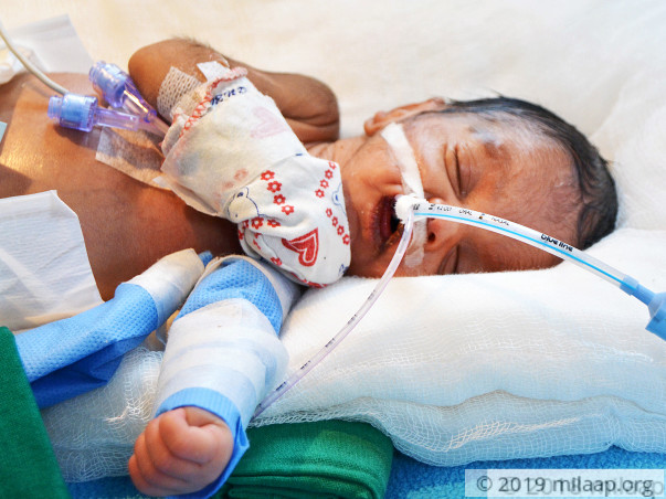 Premature Baby Girl With Underdeveloped Vital Organs Needs Urgent Help