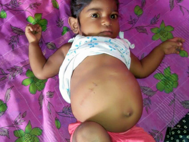 1-year-old Keerthana with a bloated stomach fights liver failure