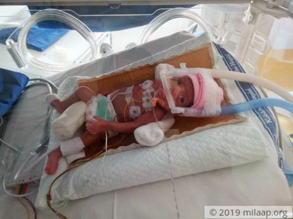 This 1/2kg Baby Girl Is A Fighter Who Is Beating Odds To Survive