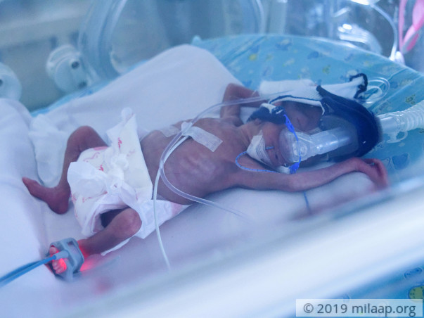 Only 600 Grams At Birth, These Twins Need Help To Survive