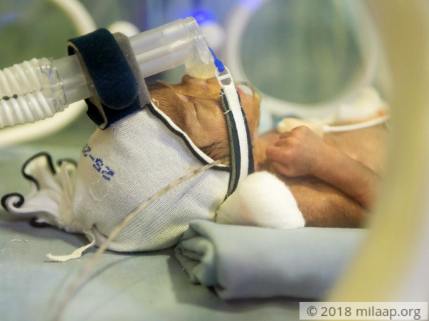 New Mother Has Not Seen Her 2-Month-Preemie Son As He Is In The ICU