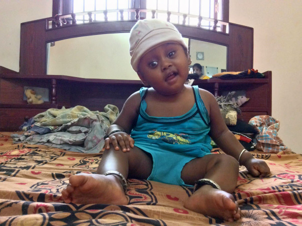 Baby Nidarshan Needs An Urgent Surgery To Replace His Skull