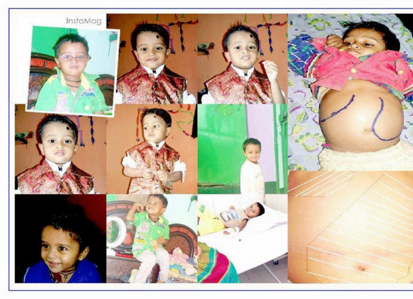 Help Ayush Fight A Rare Genetic Disorder - Gaucher Type 3