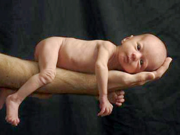 Help Preterm twin babies treatment to recover from extreme prematurity