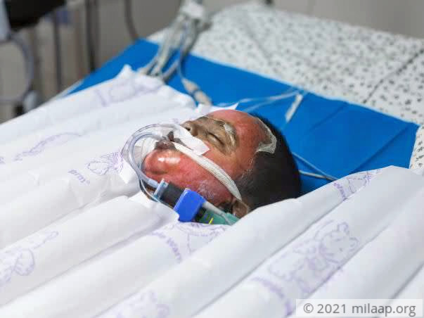 50% Of This Baby’s Body Is Burnt And He’s Struggling To Live
