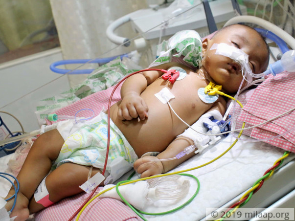 Baby Sneha needs your help to undergo her treatment