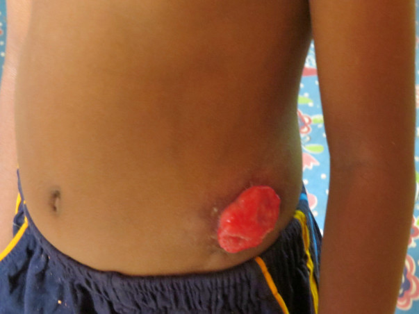 Help for 5 year old Divesh's Colostomy Closure Surgery