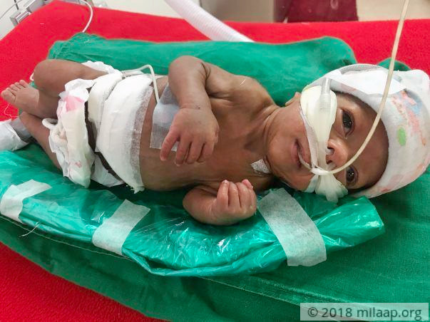 Help Vishakha and Vinayak save their premature baby boy