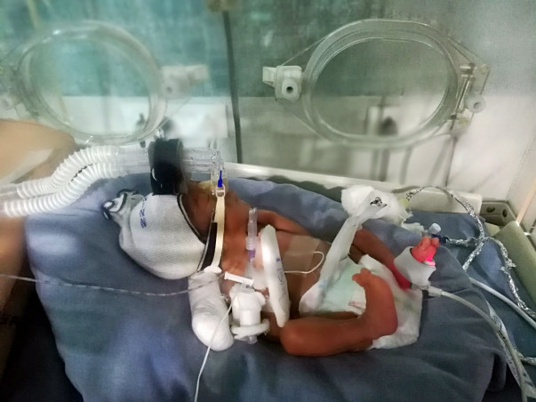 A Premature Baby Fighting A Battle To Live