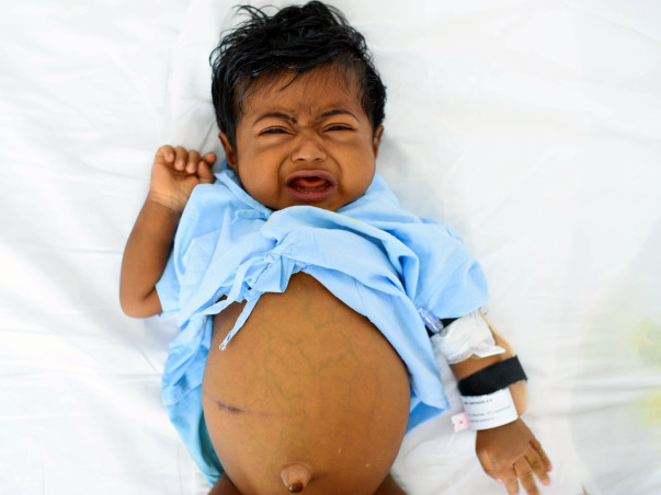 Support Baby Abhinand To Undergo a Liver Transplant