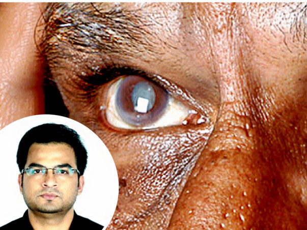 Sponsor A Cataract Surgery