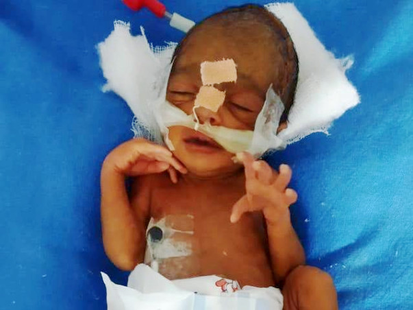 Help Baby Of Rachana Who Was Preterm (30 weeks)