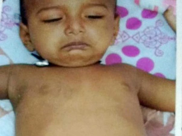 Help One Year Old Aiyan To Fight With Deadly Rare Gaucher Disease