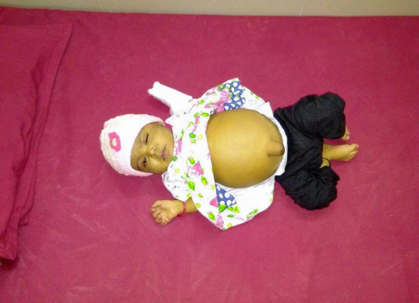 Help Baby Tahoora Begum Undergo A Liver Transplant
