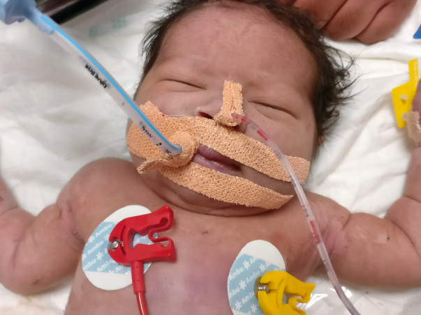Baby of Reshma need our Help