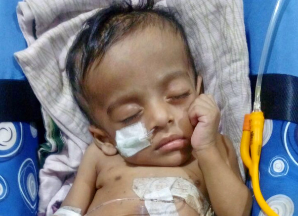 This Baby requires a surgery so that he can eat through his mouth