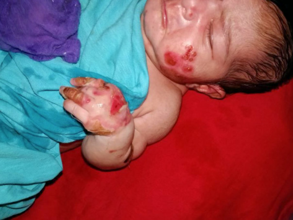 My 10-day Old daughter Is Suffering From A Skin Condition Please Help.