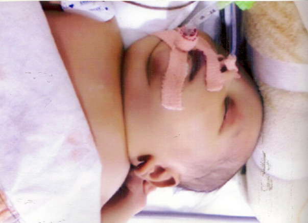 Help baby of Ramya get treatment for Sepsis