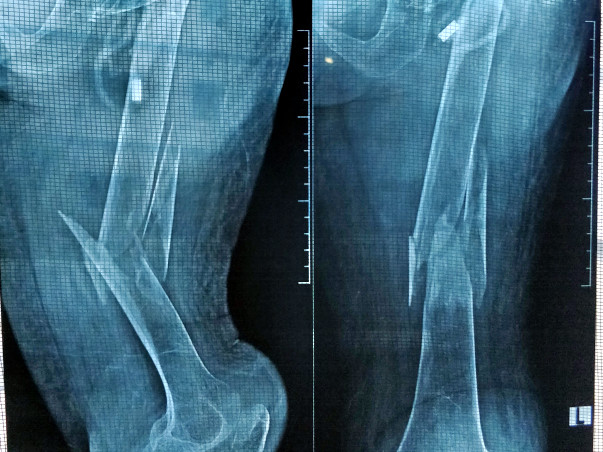 Help my grandmother for thighbone joint surgery