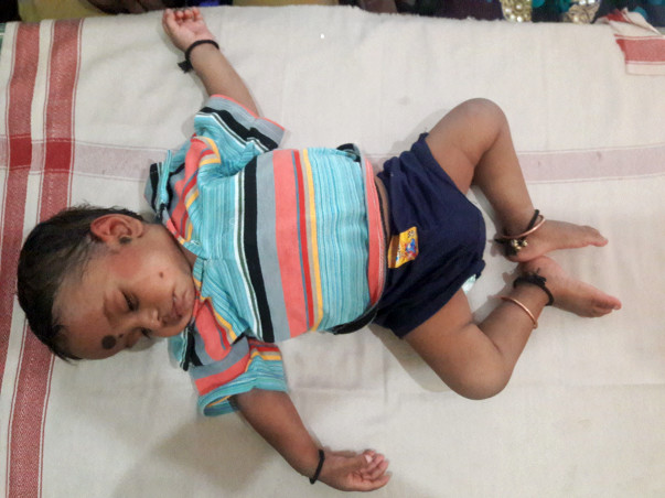 1-year-old Vignesh Has Been Suffering From Severe Diarrhea Since Birth