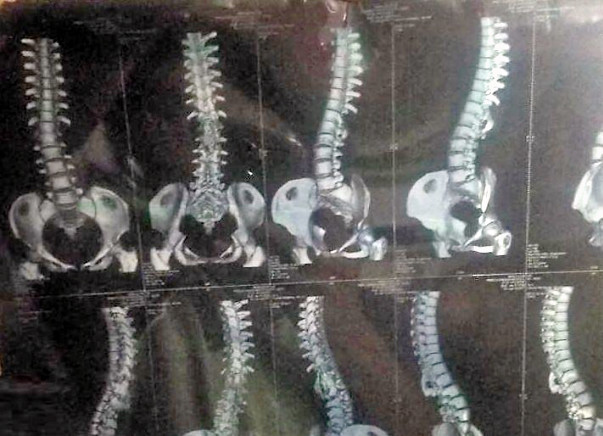 Help Manjula to undergo Backbone Surgery