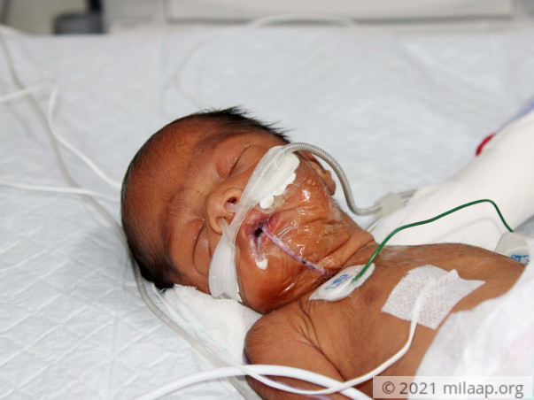 Helpless Mother Is Struggling To Save Her Premature Baby
