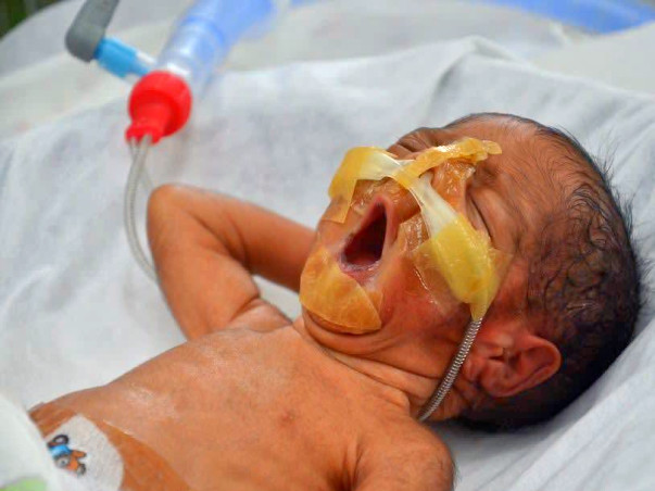 Twins Born After 26 Years Of Marriage Are Now Fighting To Survive