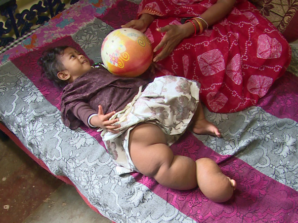 Help Pragya Fight Rare Disease