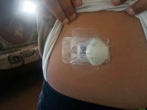 Help Shruthvidh Undergo Treatment For Type 1 Diabetes.