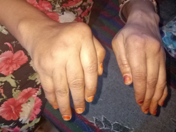 Help Me To Cure My Mother's Arthritis