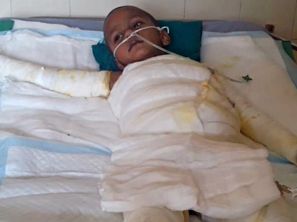 Help 4-year-old Krishive Recover From 2nd Degree Burns