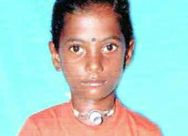 Help Sangeetha to recover from Severe Grade IV Subglotic Stenosis