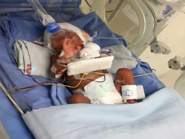 Help My Premature Baby Recover