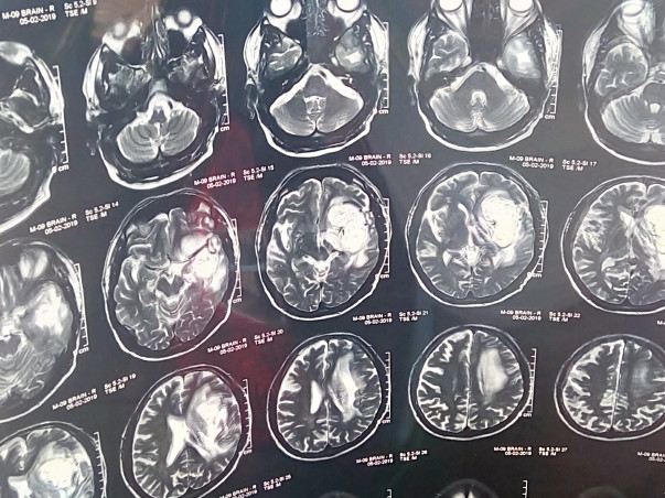 Help for Brain Surgery