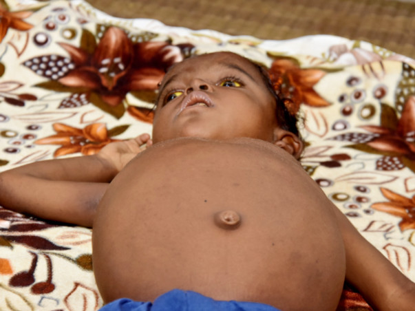 Help Adil Undergo An Urgent Liver Transplant