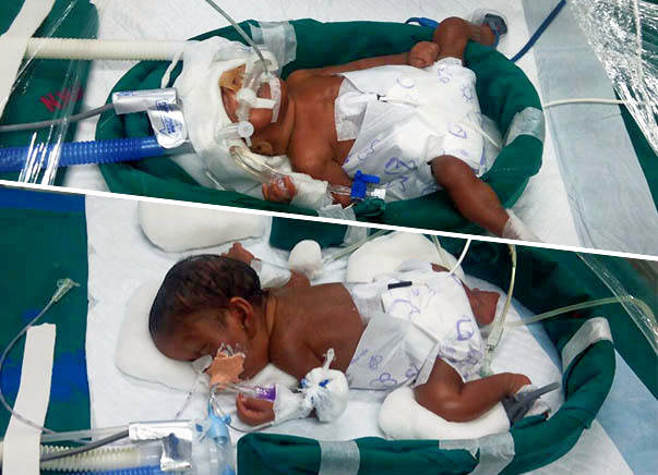 Help Premature New Born Twins To Survive