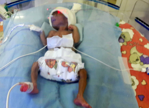 Help my premature Baby