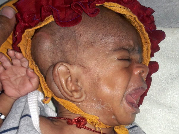Help 4-month-old Baby Suffering From Hydrocephalus