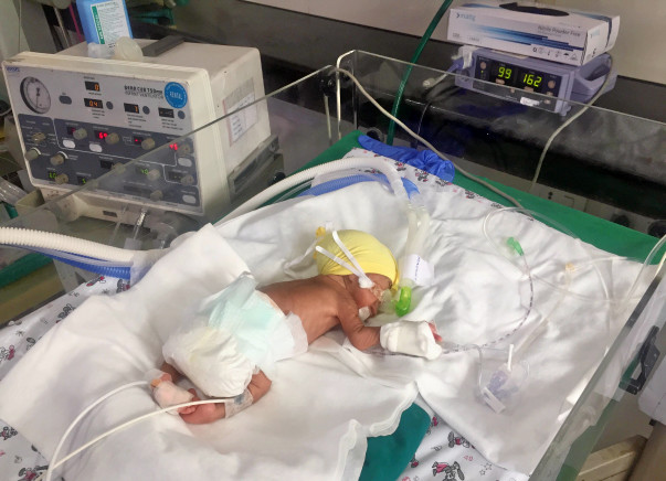Bala's Twins Are Struggling To Live And He Has Noone For Support