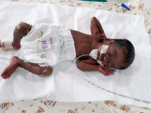 Help Twins of Amudha Get Ventilator Support