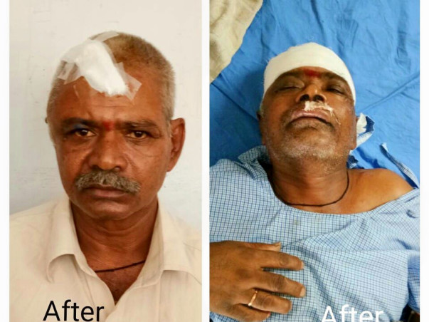 Help for Y Muthyallu double brain hemorrhage operation