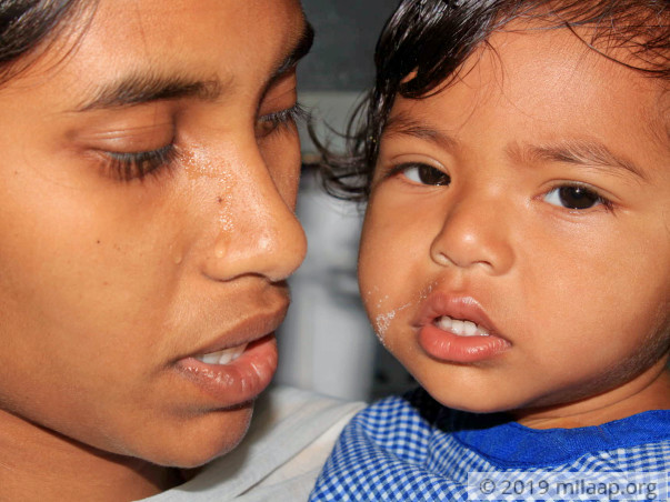 Rishvitha needs your help to undergo her treatment