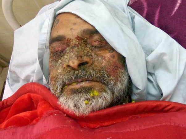 Help Mr Anil Kapil, who is in ICU, fight Sepsis and Bullous Pemphigoid